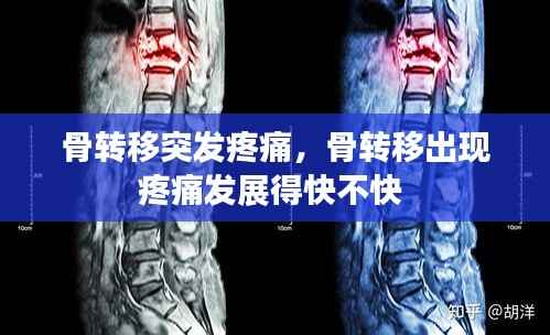 骨转移突发疼痛，骨转移出现疼痛发展得快不快 